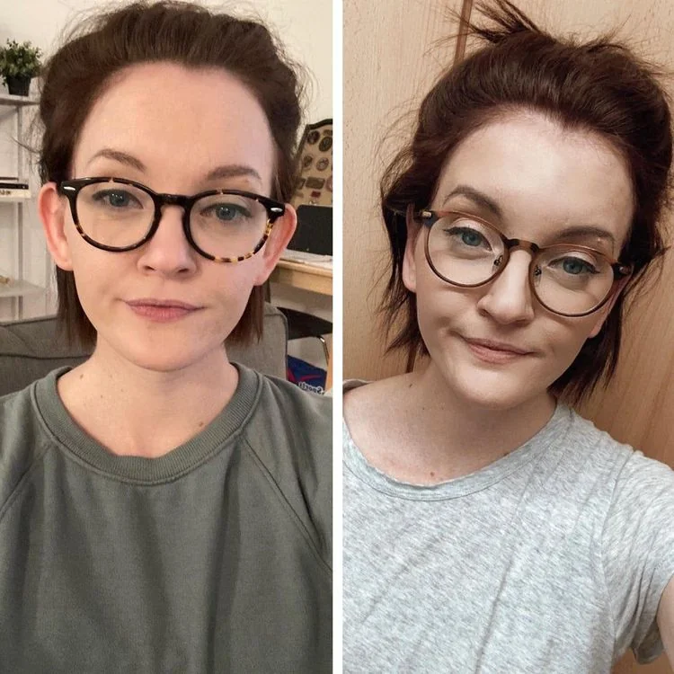 Девушка в очках с оттопыренными ушами до и после отопластики