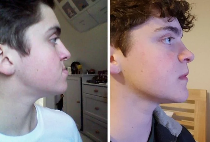 Подросток в профиль с выступающей челюстью до и после ортогнатической операции