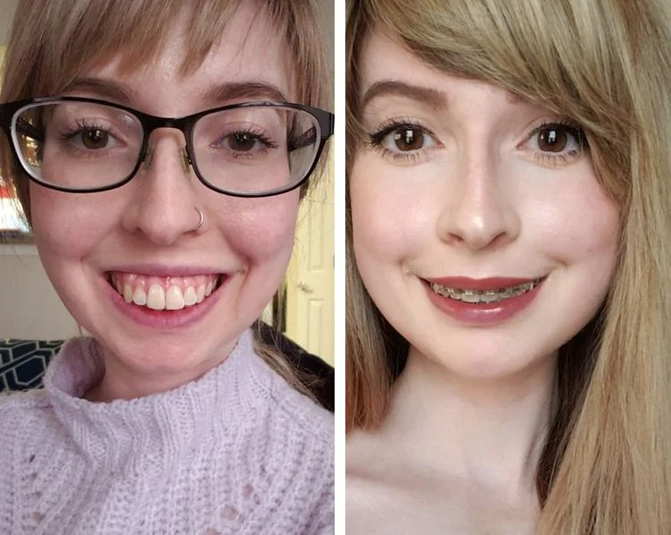 Профиль женщины со смещённой верхней челюстью до и после ортогнатической операции