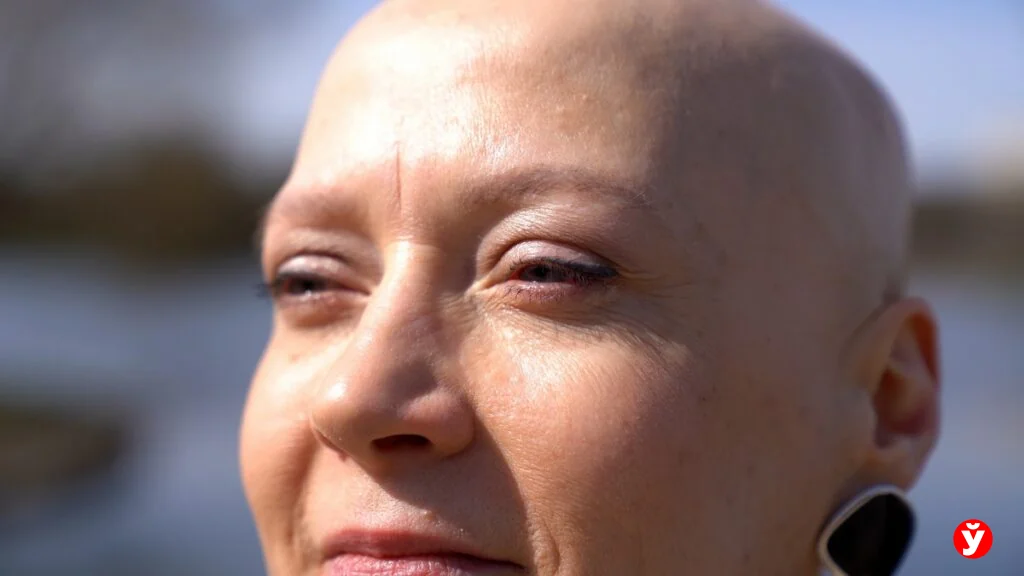 Как белоруска с алопецией прошла путь от парика до принятия себя