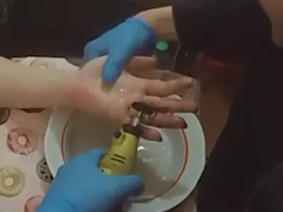 Белоруска не смогла снять кольцо — пришлось звать МЧС